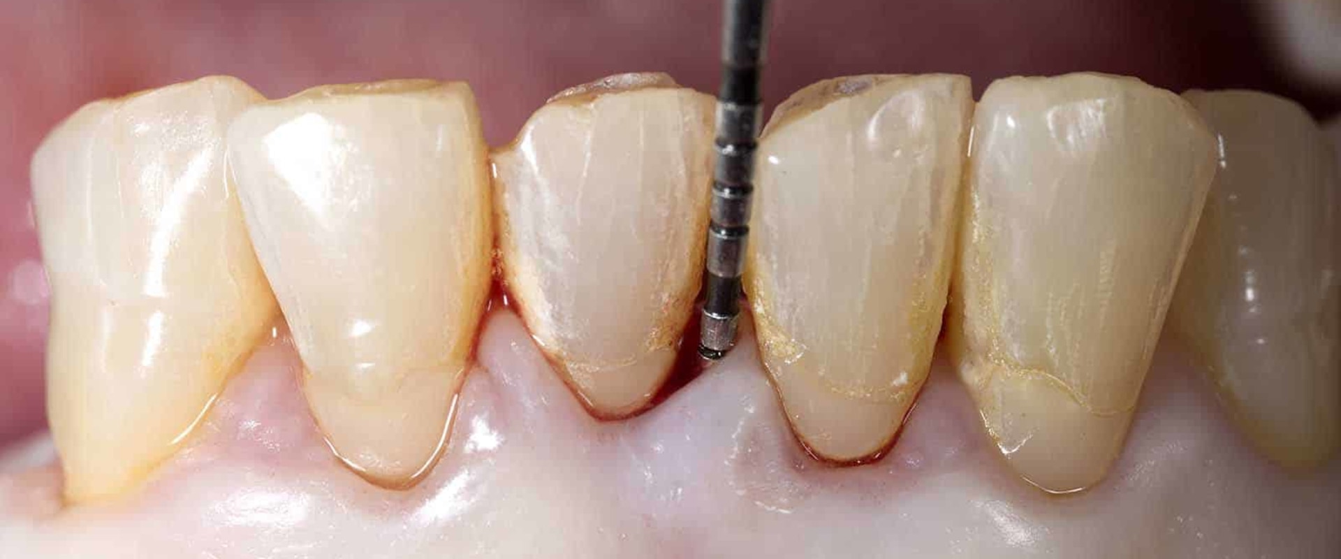 What's the difference between periodontist and endodontist?