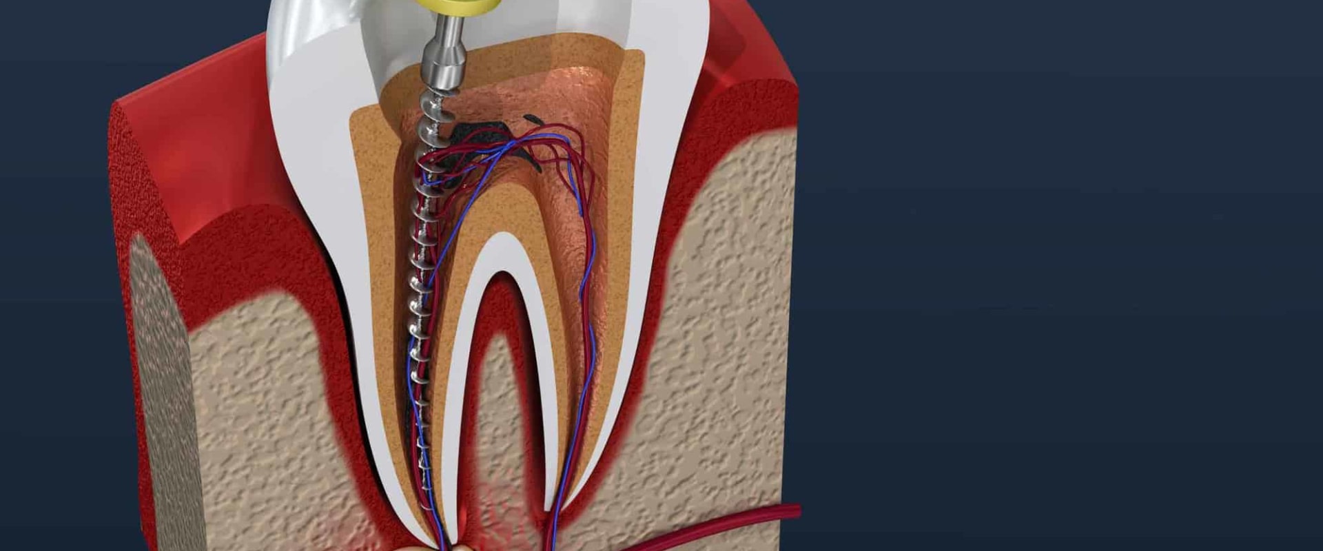 What is the Smallest Endodontic File?