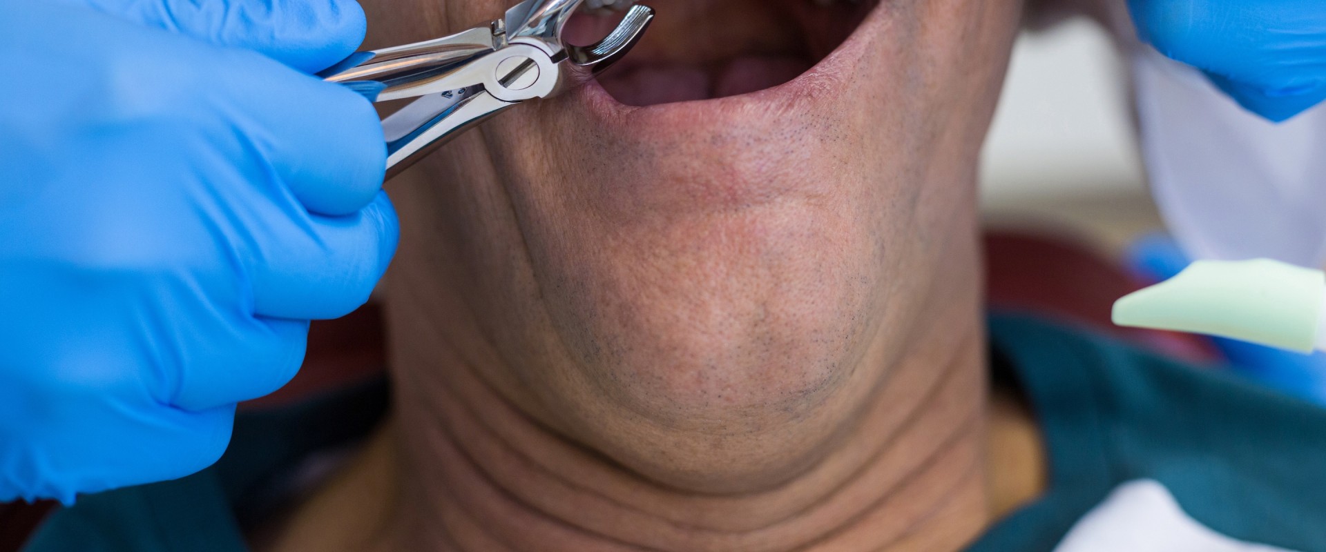 Will endodontists pull teeth?