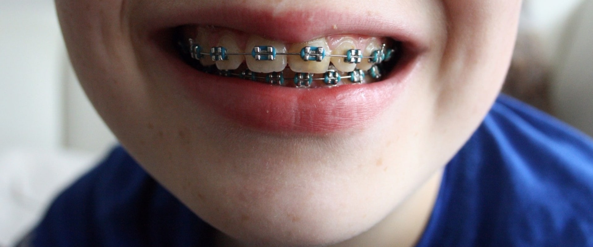 Can I Go Straight to an Endodontist?