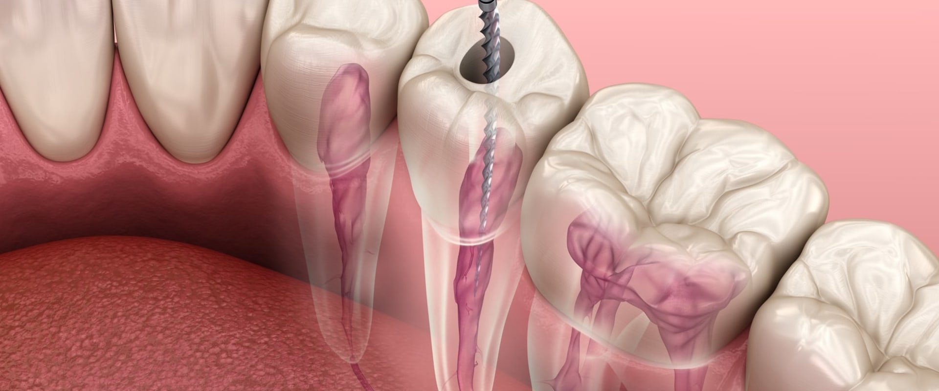 Are endodontists better at root canals?