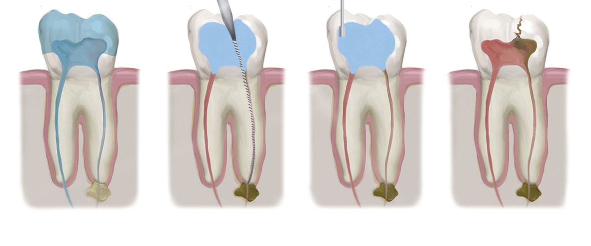 Will endodontists do crowns?