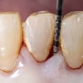 What's the Difference Between a Periodontist and an Endodontist?