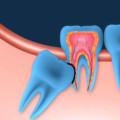 Can endodontist pull wisdom teeth?