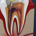 Which endodontic file is the smallest?
