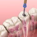 The Benefits of Seeing an Endodontist for Root Canal Treatments