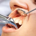 Can an Endodontist Extract a Tooth?