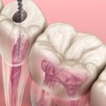Are Endodontists the Best Choice for Root Canal Treatment?