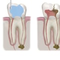 Do Endodontists Perform Crowns?