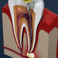 What is an Endodontist? A Comprehensive Guide