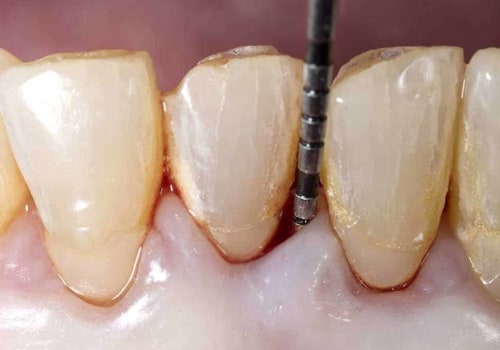 What's the difference between periodontist and endodontist?