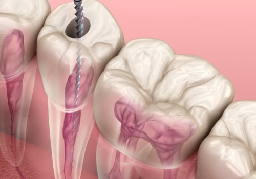 The Benefits of Seeing an Endodontist for Root Canal Treatments