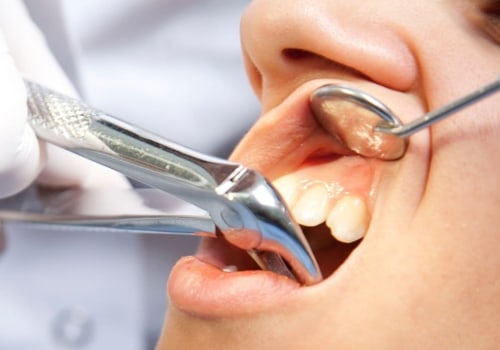 Will an endodontist extract a tooth?